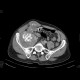 Tumour of cecum, extensive: CT - Computed tomography